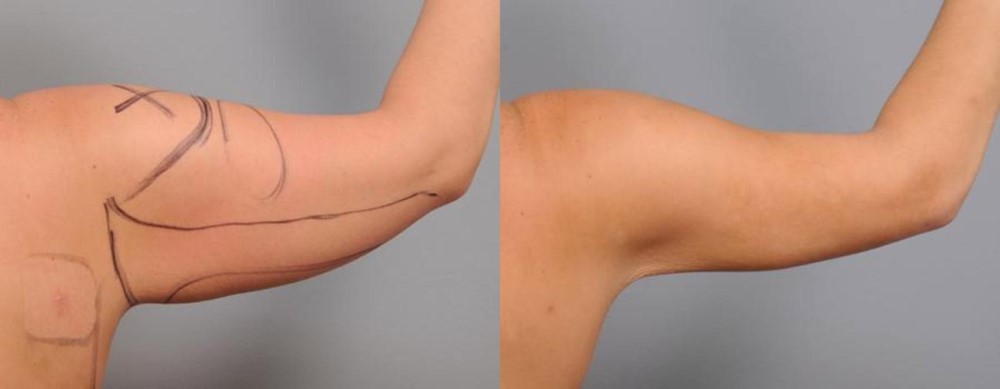 arm lipomatic