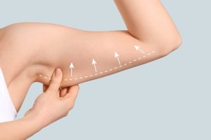arm lipomatic