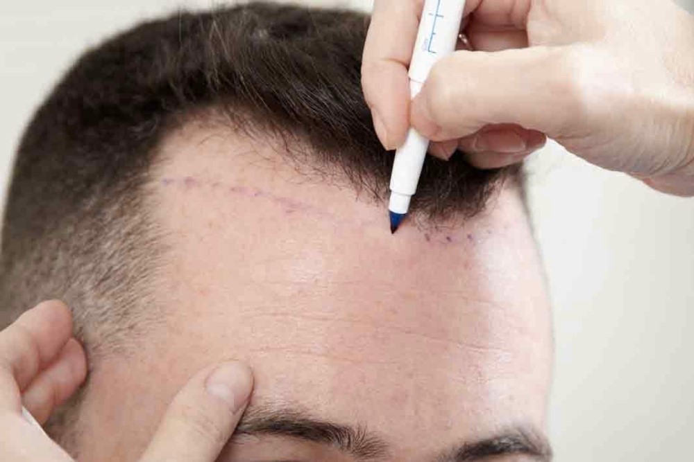 hair transplant