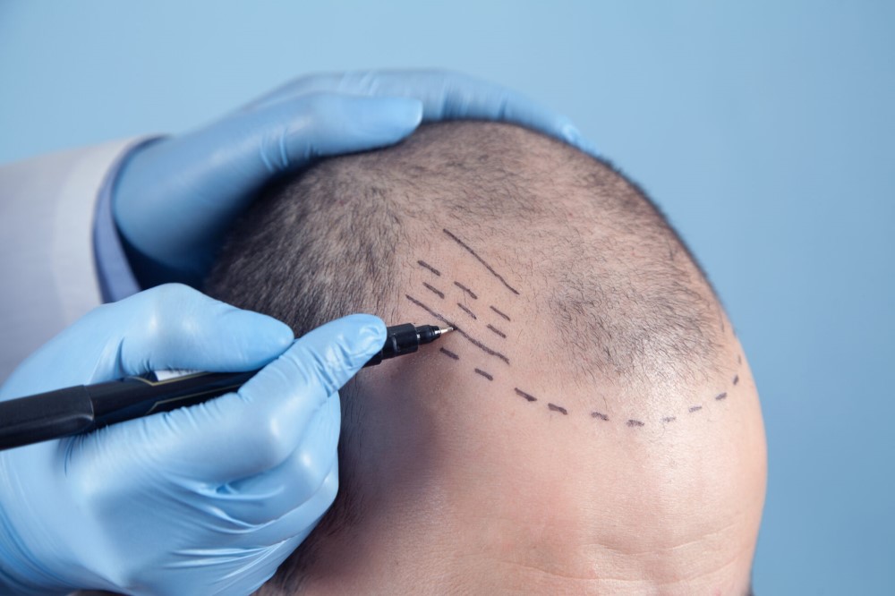 hair transplant
