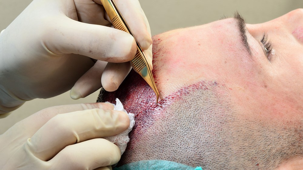 hair transplant with nano fibers