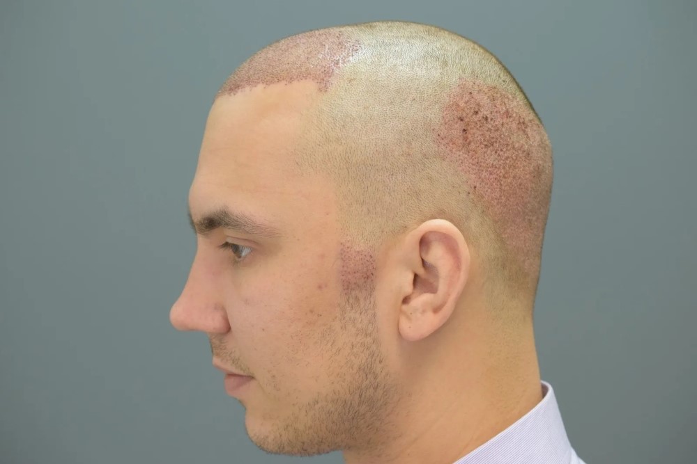 hair transplant with nano fibers