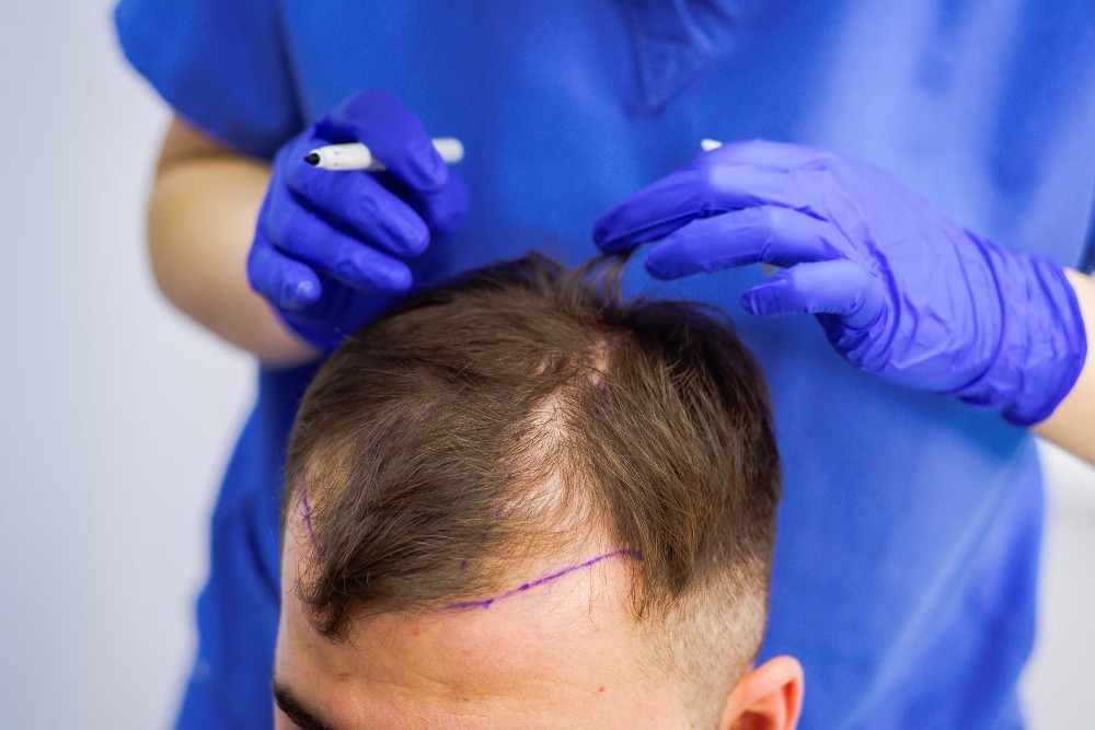 hair transplant