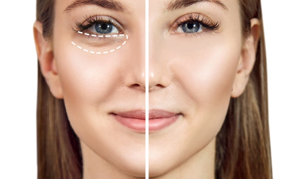 under-eye gel injection