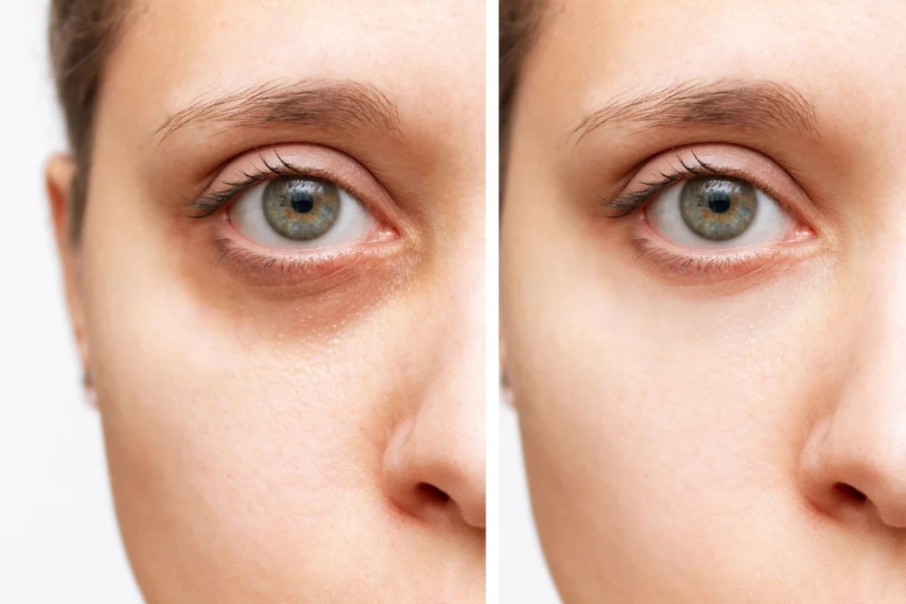 under-eye gel injection