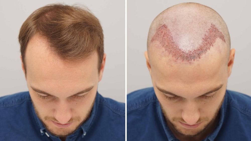 wounds after hair transplant
