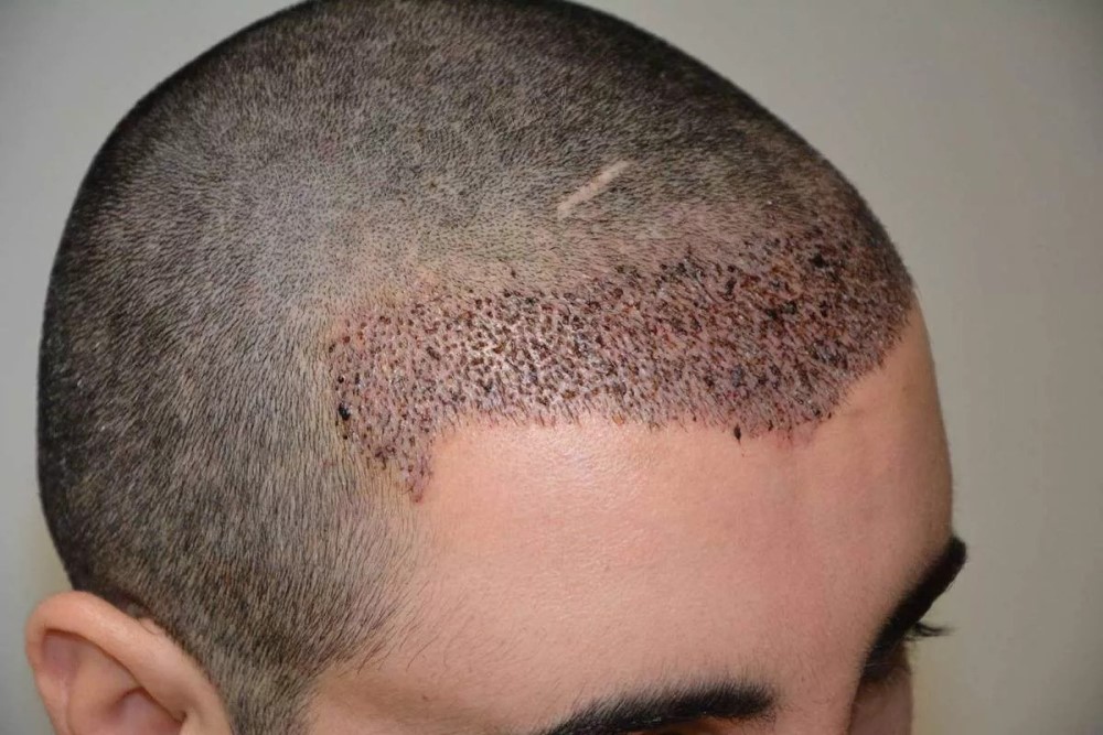 wounds after hair transplant