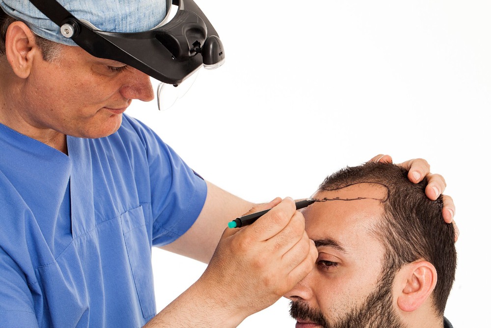 Comparison of Hair Transplant Methods
