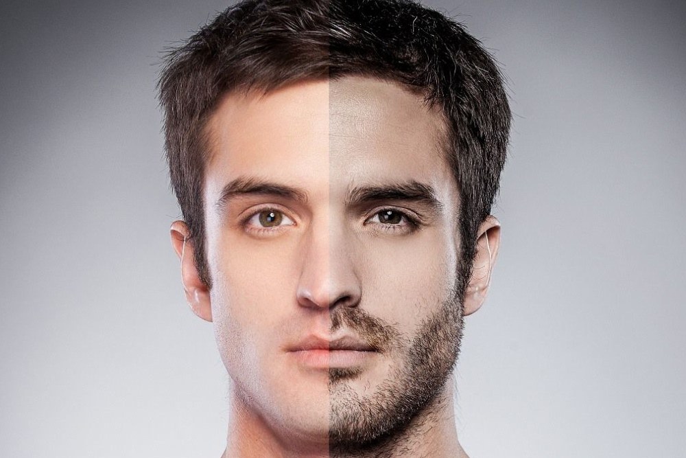 beard transplant