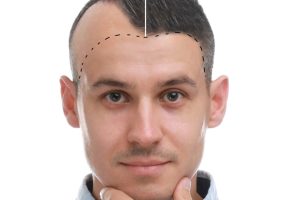 Hair Growth After Hair Transplantation