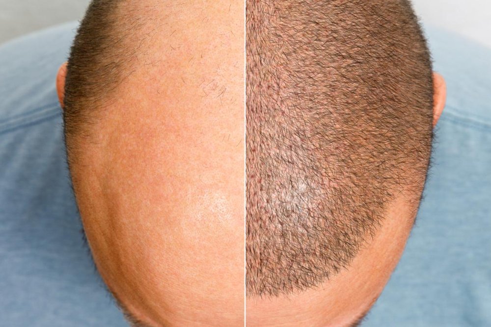 Hair Growth After Hair Transplantation