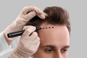 hair transplant