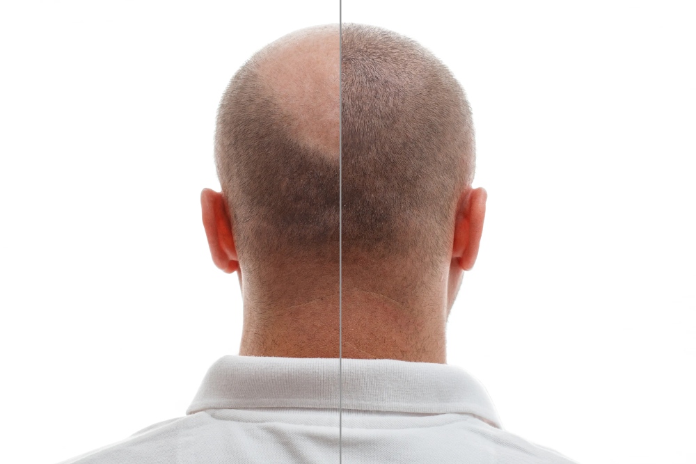 Hair Transplantation in the Vertex Area