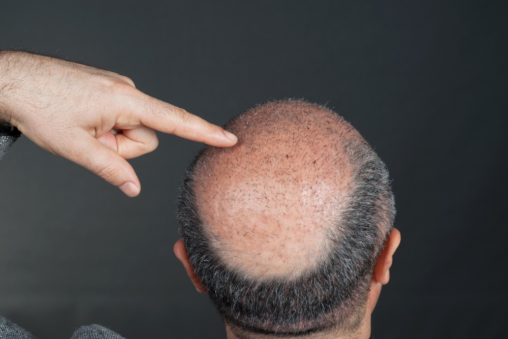 Hair Transplantation in the Vertex Area