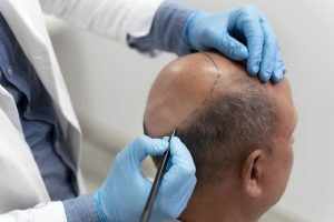 Hair Transplantation in the Vertex Area