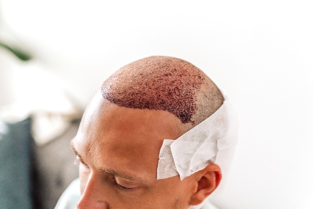 hair transplant