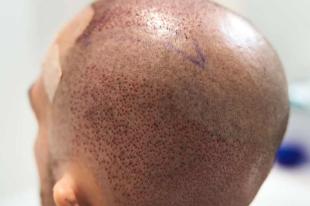 hair transplant