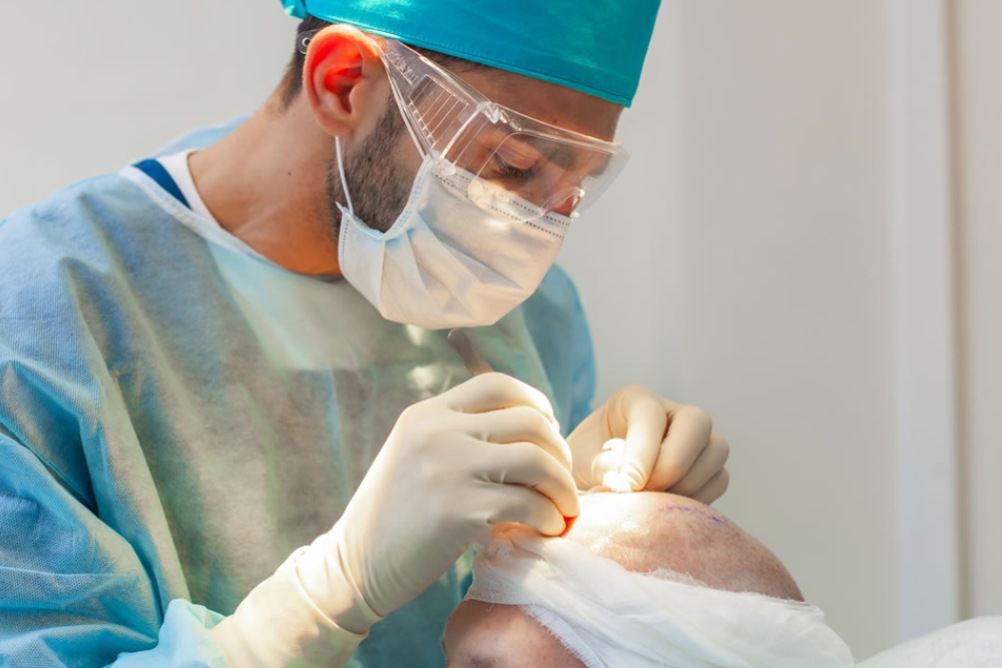 hair transplant